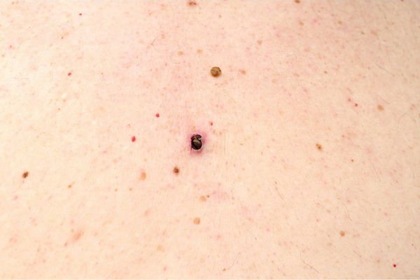 blackheads acne treatment near me - Exhale A Day Spa
