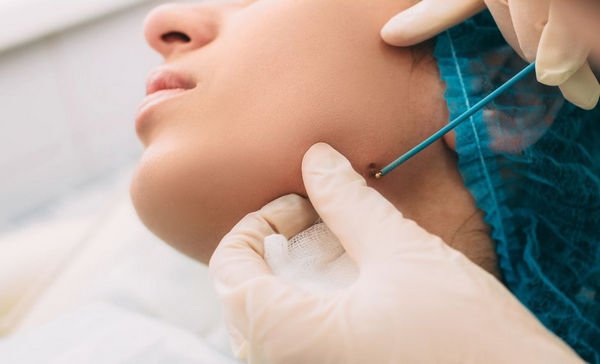 lamprobe Treatment - Most Effective Facial Treatments for Anti-Aging