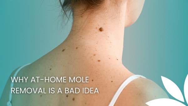 Why At-Home Mole Removal Is a Bad Idea